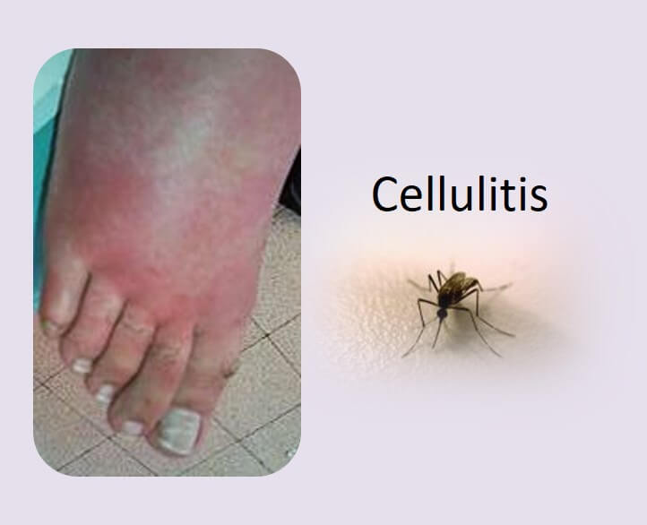 צלוליט - טיפ צלוליט בעור זה לא 'צלוליטיס'- שושנה erysipelas Cellulitis